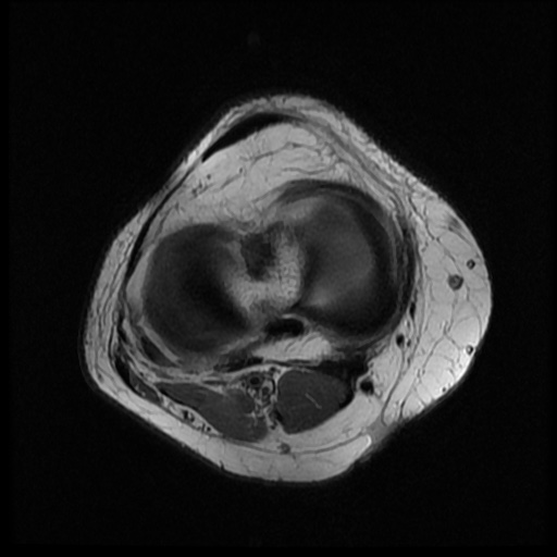 File:Bucket handle meniscus tear (Radiopaedia 56916-63751 Axial PD 13).jpg