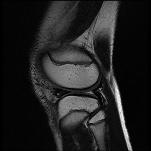 File:Bucket handle tear - lateral meniscus (Radiopaedia 72124-82634 Sagittal T2 3).jpg