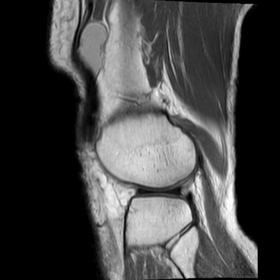 File:Bucket handle tear - medial meniscus (Radiopaedia 29250-29664 Sagittal PD 4).jpg