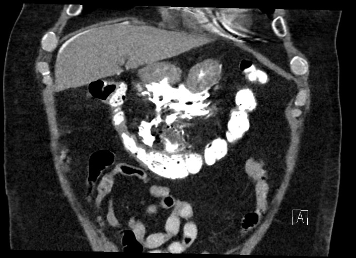 Buried bumper syndrome - gastrostomy tube (Radiopaedia 63843-72577 Coronal Inject 37).jpg