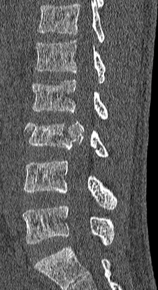 Burst fracture (Radiopaedia 53373-59357 Sagittal bone window 37).jpg