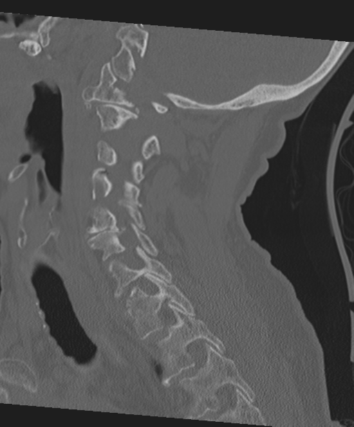 C2 fracture with vertebral artery dissection (Radiopaedia 37378-39199 Sagittal bone window 31).png