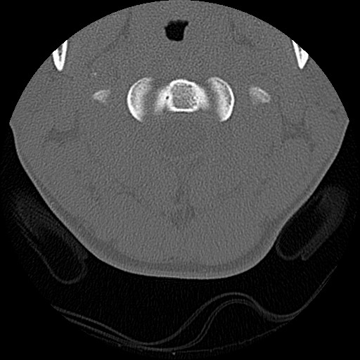 File:C5 facet fracture (Radiopaedia 58374-65499 Axial bone window 19).jpg