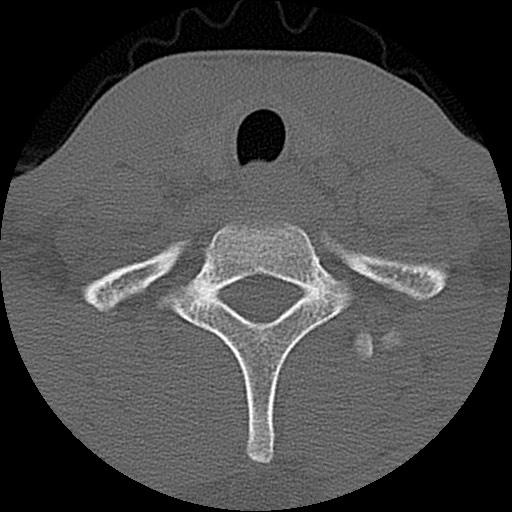 File:C5 facet fracture (Radiopaedia 58374-65499 Axial bone window 80).jpg