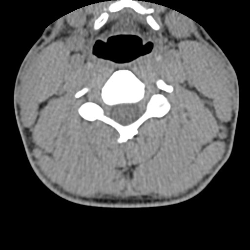 C5 facet fracture (Radiopaedia 58374-65499 Axial non-contrast 47).jpg