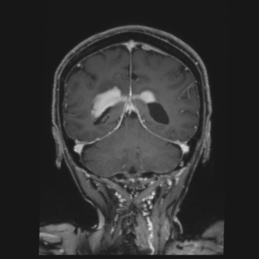 CNS lymphoma with steroid response (Radiopaedia 37980-39921 Coronal T1 C+ 34).png