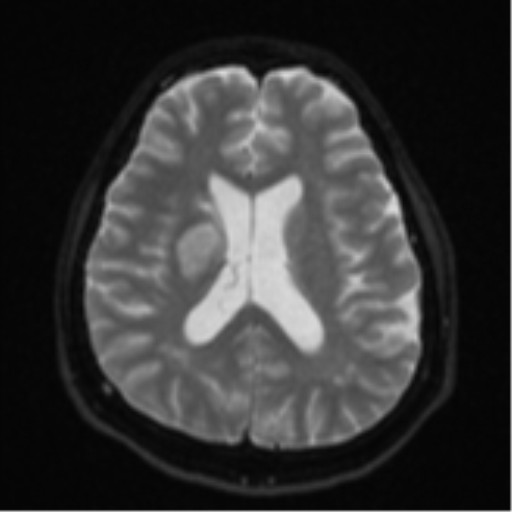 File:CNS vasculitis (Radiopaedia 55715-62263 Axial DWI 18).png
