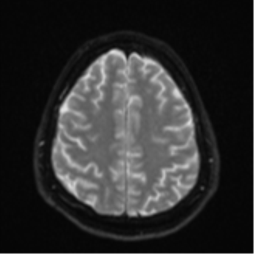 File:CNS vasculitis (Radiopaedia 55715-62263 Axial DWI 23).png