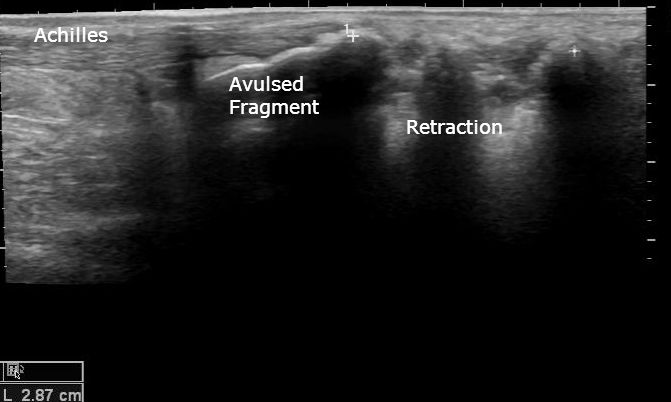 File:Calcaneal tuberosity avulsion fracture - ultrasound (Radiopaedia 29978-30524 C 1).jpg
