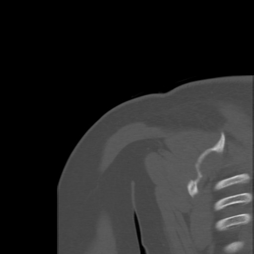 File:Calcific tendinitis of the infraspinatus tendon (Radiopaedia 87256-103539 Coronal bone window 49).jpg