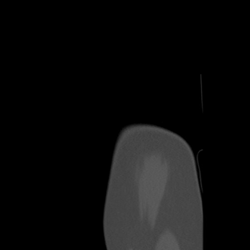 File:Calcific tendinitis of the infraspinatus tendon (Radiopaedia 87256-103539 Sagittal bone window 6).jpg