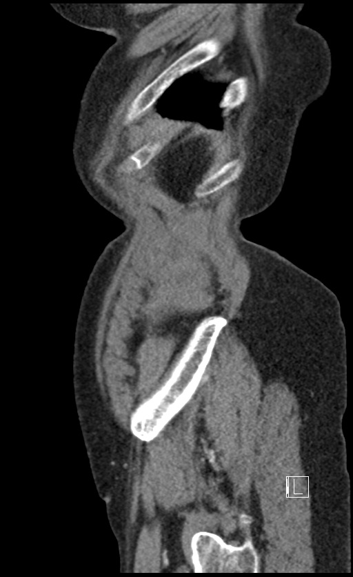 Calcified adrenal glands and Spigelian hernia (Radiopaedia 49741-54988 C 15).jpg