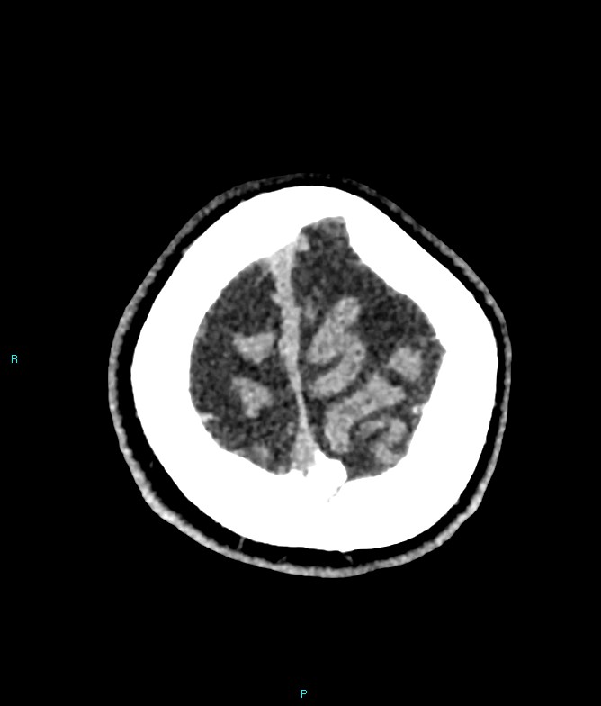 Calcified cerebral emboli from left ventricular thrombus (Radiopaedia 84420-99758 Axial non-contrast 11).jpg
