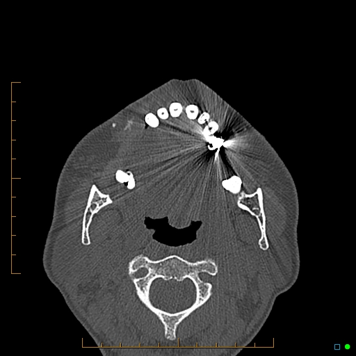Calcified facial augmentation fillers (Radiopaedia 79514-92679 Axial bone window 101).jpg