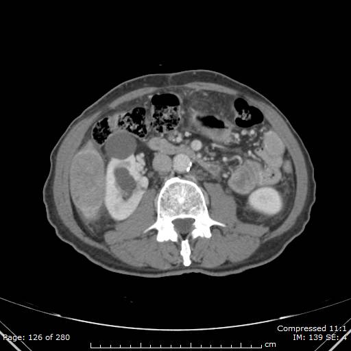 Calcified liver metastases (Radiopaedia 44699-48470 B 45).jpg