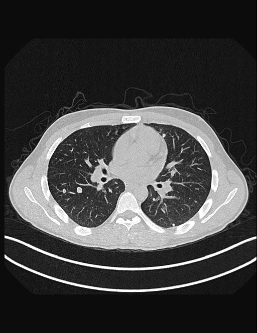 Calcifying pulmonary metastases (Radiopaedia 33359-34396 Axial lung window 32).jpg