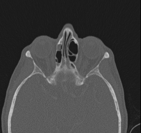 Caldwell-Luc operation (Radiopaedia 52329-58225 Axial bone window 21).jpg