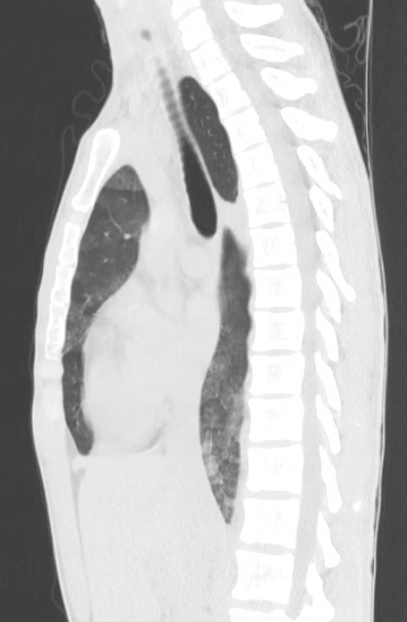 Cannabis-induced diffuse alveolar hemorrhage (Radiopaedia 89834-106946 Sagittal lung window 65).jpg