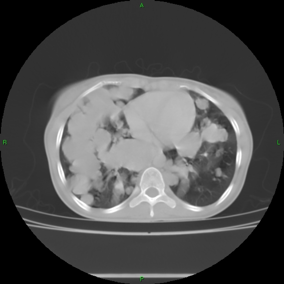 File:Cannon ball metastases - synovial sarcoma (Radiopaedia 26135-26271 Axial lung window 25).jpg