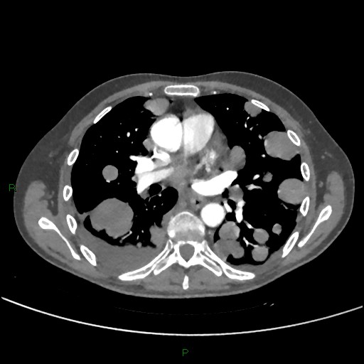 Cannonball metastases (Radiopaedia 82110-96150 Axial C+ CTPA 167).jpg