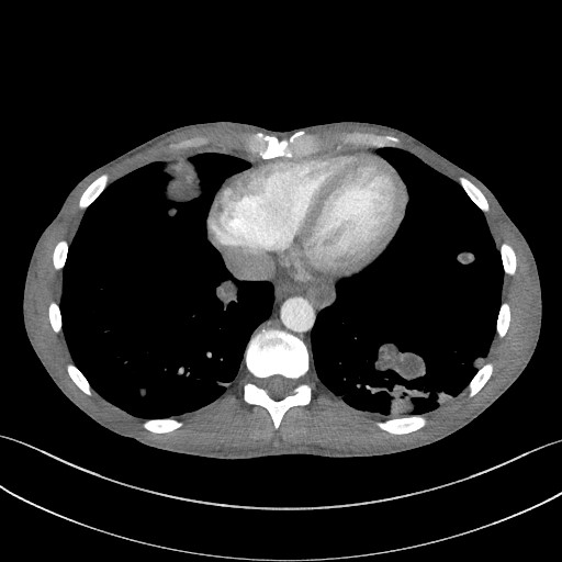 Cannonball metastases - testicular choriocarcinoma (Radiopaedia 84510-99891 B 83).jpg