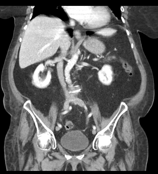 Cannonball metastases from endometrial cancer (Radiopaedia 42003-45031 F 38).png