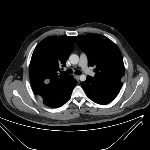 File:Cannonball pulmonary metastases (Radiopaedia 67684-77101 D 114).jpg