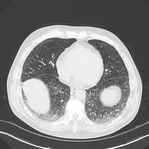 Caplan syndrome (Radiopaedia 56667-63530 Axial lung window 136).jpg