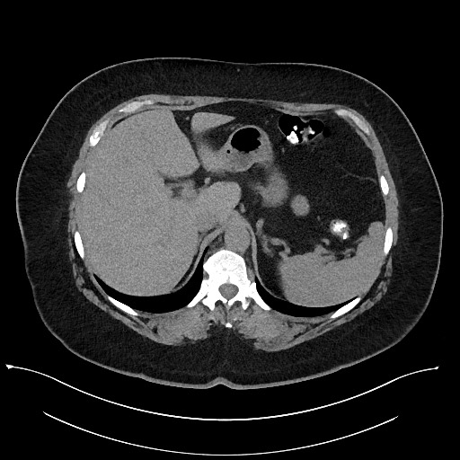 File:Carcinoid tumor - terminal ileum (Radiopaedia 60931-68740 Axial non-contrast 20).jpg