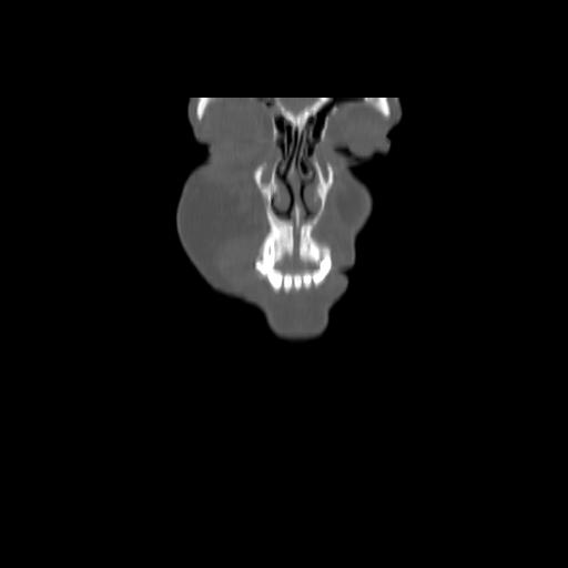 Carcinoma of the maxillary antrum (Radiopaedia 53805-59888 Coronal bone window 17).jpg