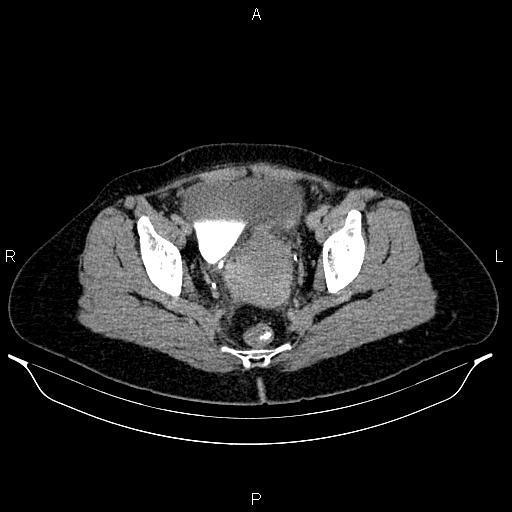 File:Carcinoma of uterine cervix (Radiopaedia 85861-101700 Axial C+ delayed 80).jpg
