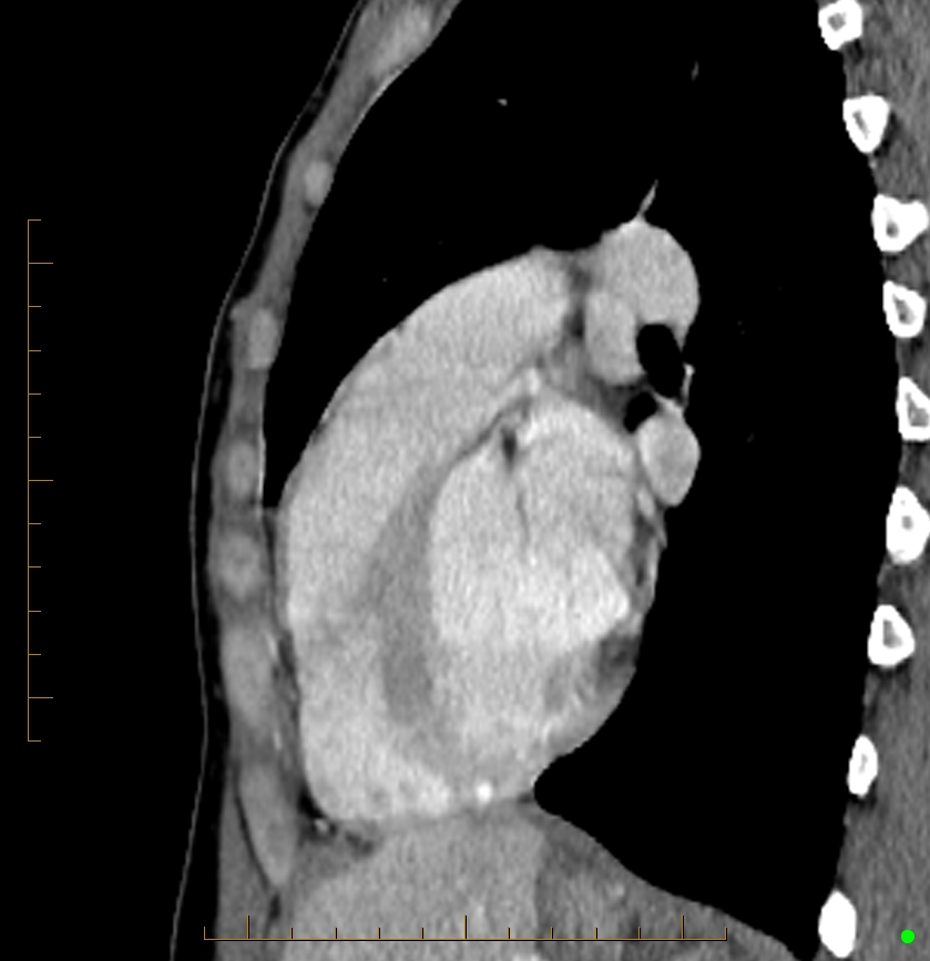 Cardiac paraganglioma (Radiopaedia 76345-88005 C 37).jpg