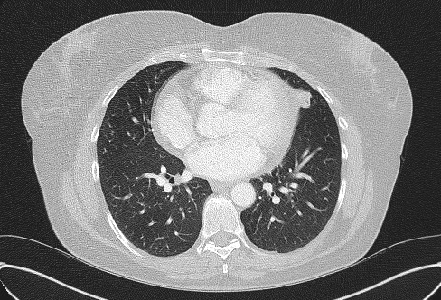 Cardiac sarcoidosis (Radiopaedia 74548-85534 Axial lung window 51).jpg