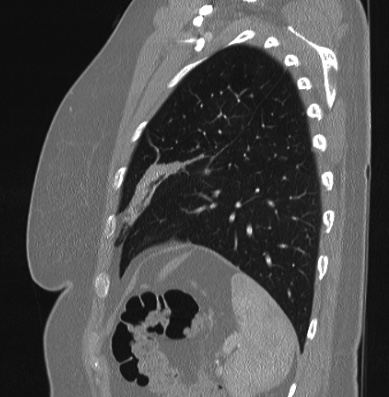 Cardiac sarcoidosis (Radiopaedia 74548-85534 Sagittal lung window 17).jpg