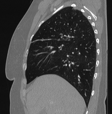 Cardiac sarcoidosis (Radiopaedia 74548-85534 Sagittal lung window 68).jpg