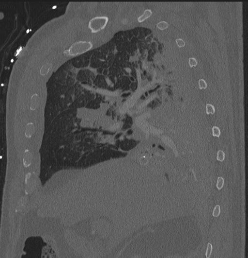 Cardiac trauma (Radiopaedia 32874-33858 Sagittal bone window 77).jpg