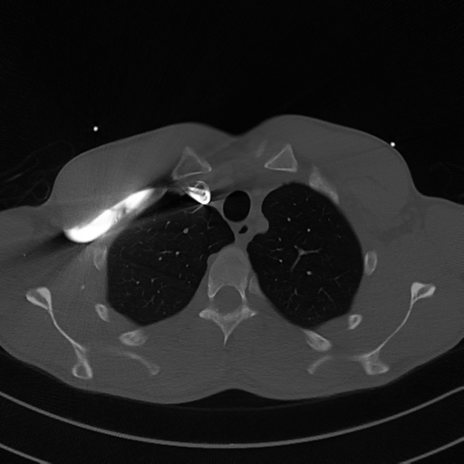 Cardiac tumor - undifferentiated pleomorphic sarcoma (Radiopaedia 45844-50134 Axial bone window 13).png