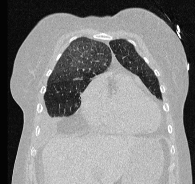 Cardiogenic pulmonary edema (Radiopaedia 29213-29609 Coronal lung window 15).jpg