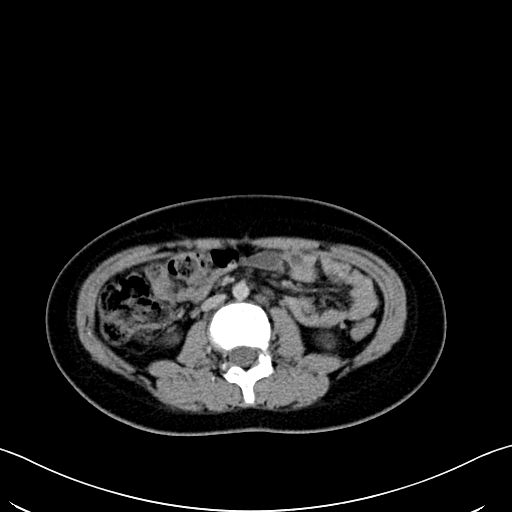 File:Caroli disease with medullary sponge kidney (Radiopaedia 82622-96804 C 37).jpg