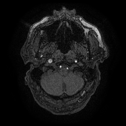 Carotid arterial dissection with acute cerebral infarction (Radiopaedia 26636-26784 MRA 160).jpg