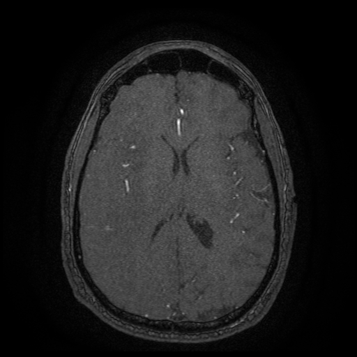 Carotid arterial dissection with acute cerebral infarction (Radiopaedia 26636-26784 MRA 60).jpg