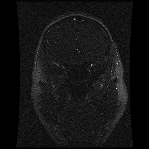 Carotid arterial dissection with acute cerebral infarction (Radiopaedia 26636-26784 MRV 119).jpg