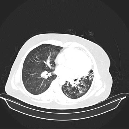 File:Carotid body tumor (Radiopaedia 21021-20948 Axial lung window 24).jpg