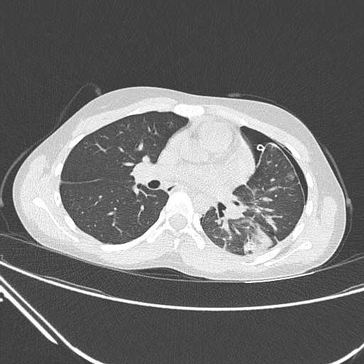 Catamenial pneumothorax (Radiopaedia 27946-28197 lung window 79).jpg
