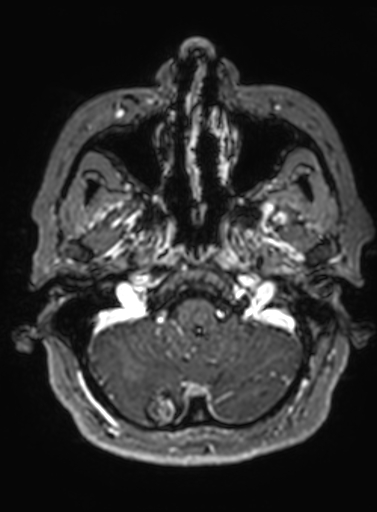 File:Cavernous hemangioma of the cerebellar falx (Radiopaedia 73025-83724 Axial T1 C+ 288).jpg