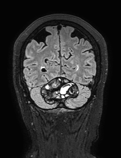 Cavernous hemangioma of the cerebellar falx (Radiopaedia 73025-83724 Coronal FLAIR 289).jpg