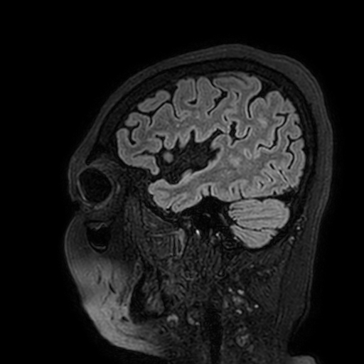 Cavernous hemangioma of the cerebellar falx (Radiopaedia 73025-83724 Sagittal FLAIR 35).jpg