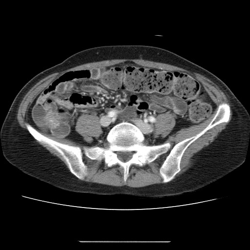 File:Cavernous hepatic hemangioma (Radiopaedia 75441-86667 B 80).jpg