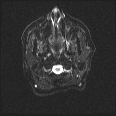 Cavernous sinus meningioma (Radiopaedia 63682-72367 DWI 1).jpg