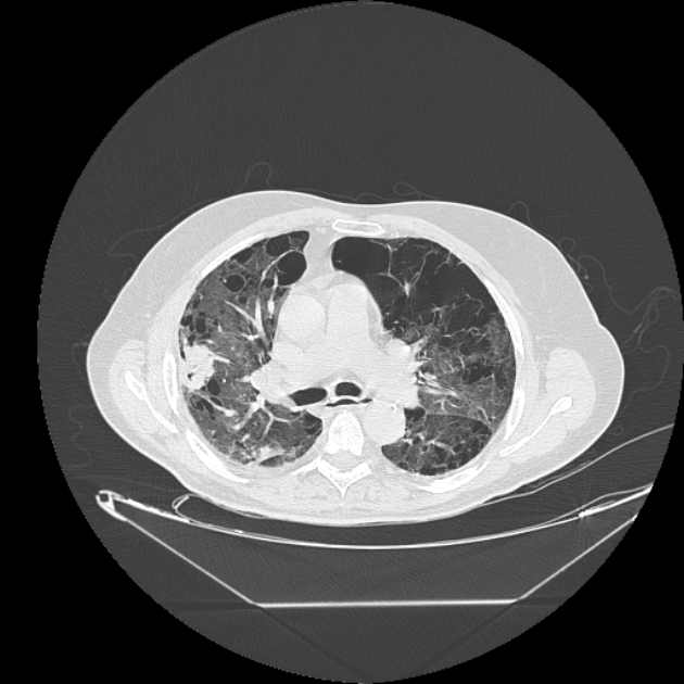Cavitating bronchogenic carcinoma (Radiopaedia 44489-48162 Axial lung window 34).jpg